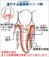 進行する歯周病(イメージ図)
